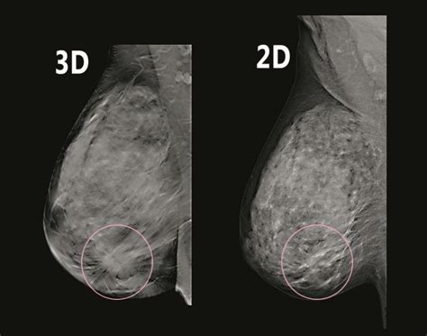 the villages digital mammography|3D Mammography .